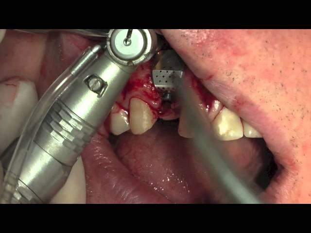 i Gen membrane with AnyRidge implant