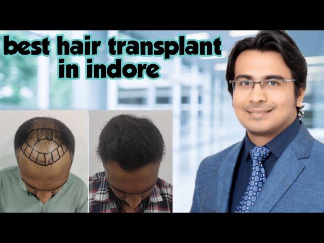 Hair transplant in indore | 6 months update | best cost & result in indore | avista clinics