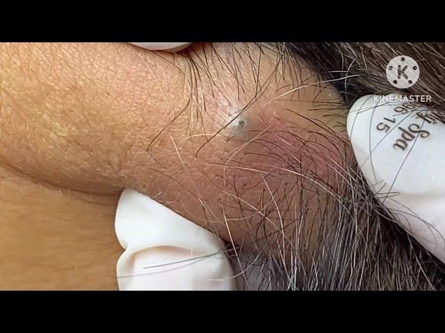 sebaceous cyst behind the neck #HoangMySpa78