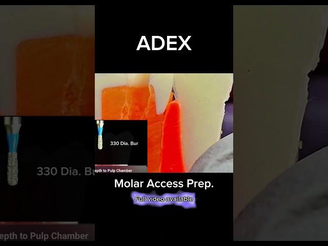 [ADEX] Endo_Posterior Access Prep #drsung #dentist #ADEX #ADEXENDO