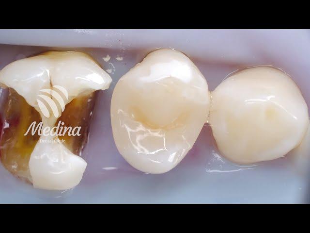 AESTHETICS.. Proses perawatan saluran akar dan tambal gigi belakang | Medina Dental Clinic