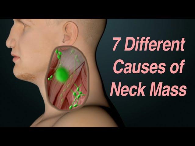 Adult Neck Mass: 7 Different Causes Based on Location