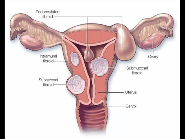 Mayo Clinic Minute - Nonsurgical treatment for uterine fibroids