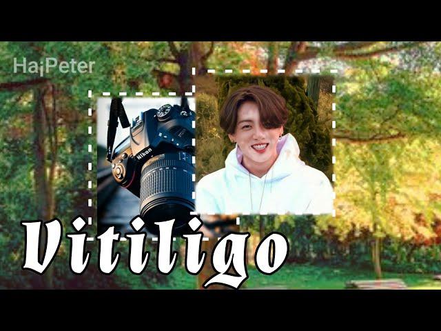 Asmr Jungkook (fanboy) - " Vitiligo "