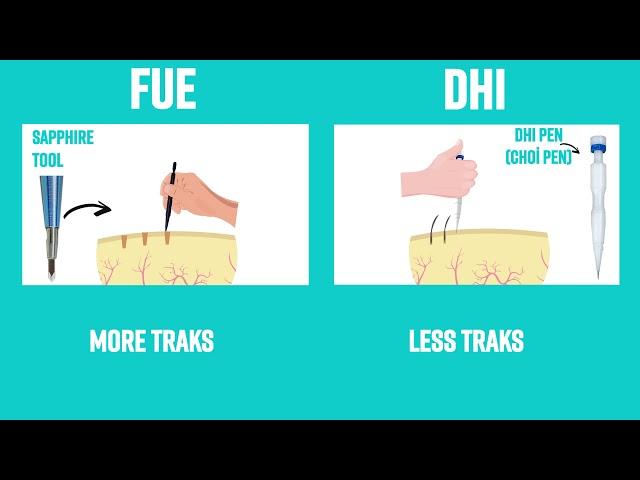 DHI Vs. FUE Hair Transplant | Which Is Better? | Advantages & Disadvantages | Cosmeticium