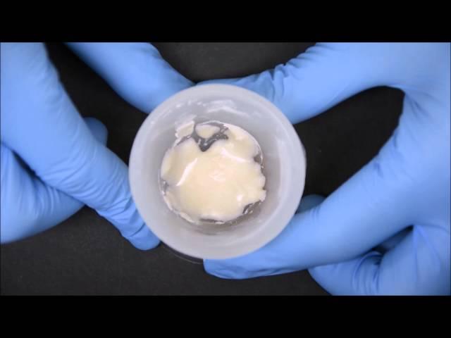 PROVISIONAL RESTORATION - INDIRECT DIRECT TECHNIQUE - 3 UNIT FPD