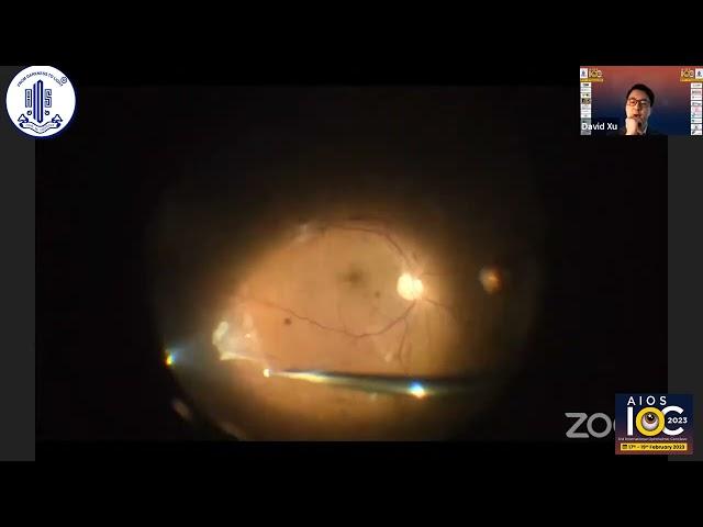 Diabetic TRD Surgery -Dr. David Xu
