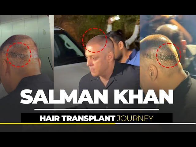 Salman Khan Hair Transplant Journey | Dadu Medical Centre