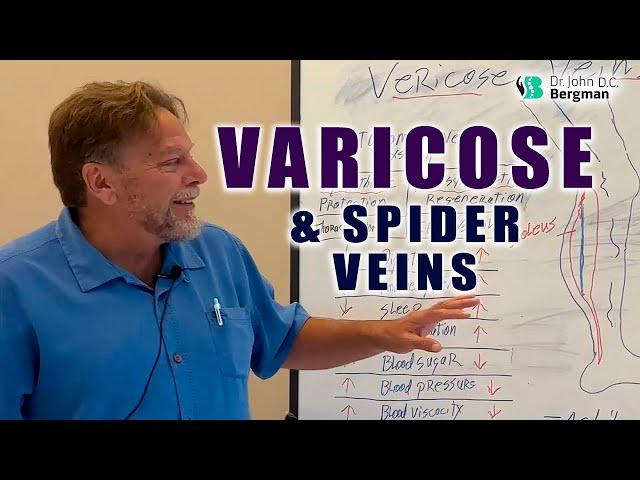 Varicose & Spider Veins