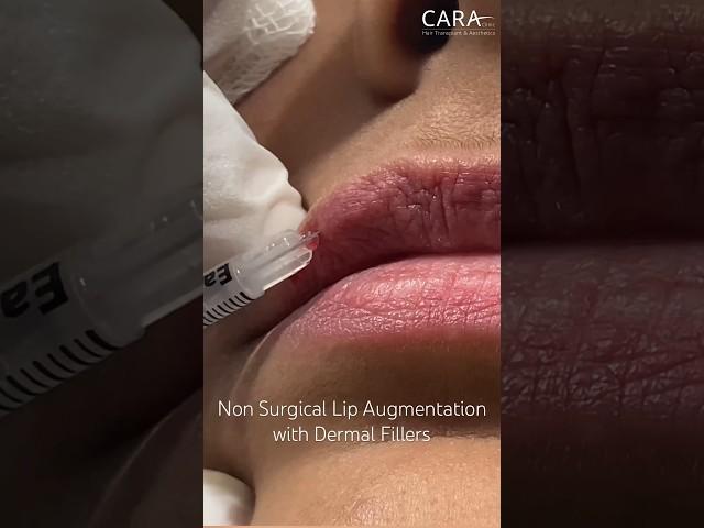 Lip Augmentation with Dermal Fillers at CARA Clinic Mumbai #lipfillers