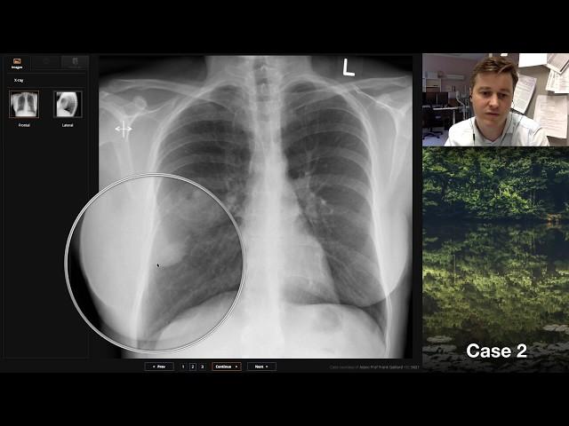 Isolation tutorial: Chest x-ray with Andrew Dixon