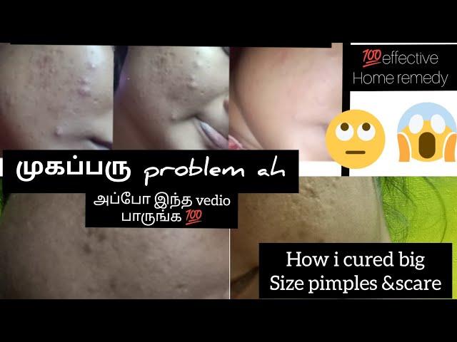 how i clear my pimples in 7days||effective home remedy ||cure pimple &scars||truth 