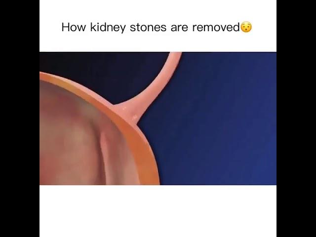 How kidney stones are removed