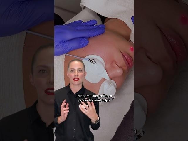 Laser Genesis Skin Treatment for Skin Redness and Rosacea