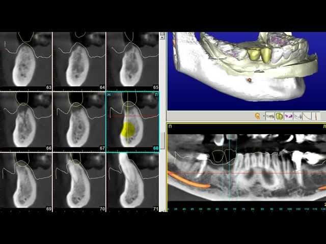 Хирургические шаблоны - Планирование операции по имплантации зубов