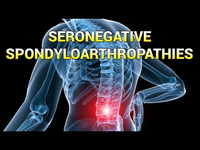 Seronegative Spondyloarthropathies (updated 2023) - CRASH! Medical Review Series