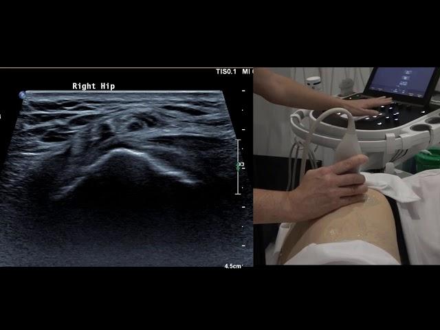 Sonoanatomy Lateral Hip tendons - Ultrasound probe positioning