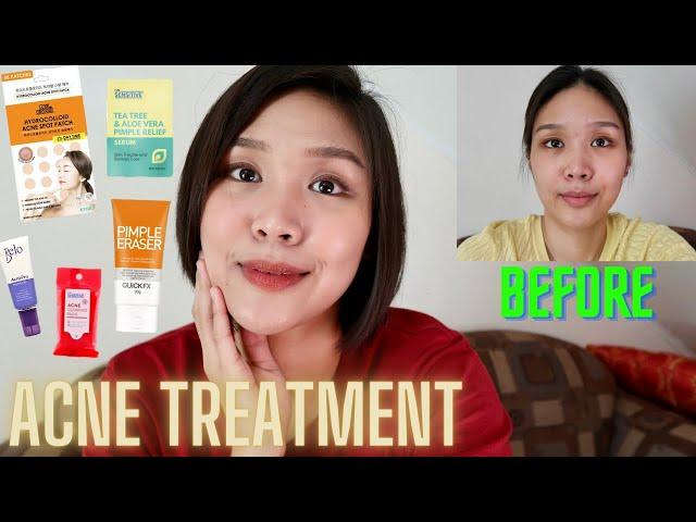 EFFECTIVE ACNE TREATMENT (NO NEED TO GO TO THE DERMA!) | lovewendyxdiane