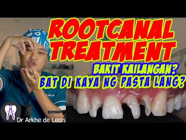 Root Canal Treatment or Therapy Explained #51