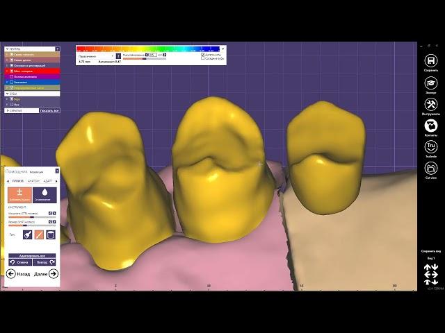 Exocad моделировка каркаса под 3D печать