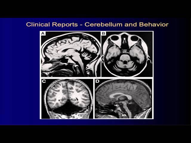 UNM Department of Psychiatry Grand Rounds: Jeremy D. Schmahmann, M.D.