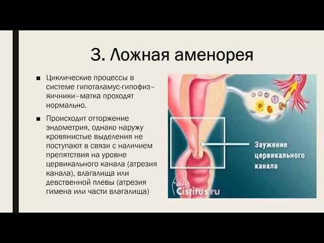 Нарушения менструального цикла. Аменорея. ДМК. Дисменорея.