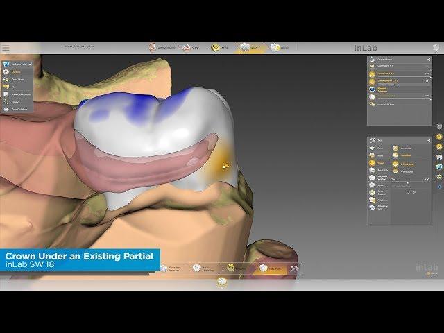 inLab SW 18: How To Do a Crown Under an Existing Partial