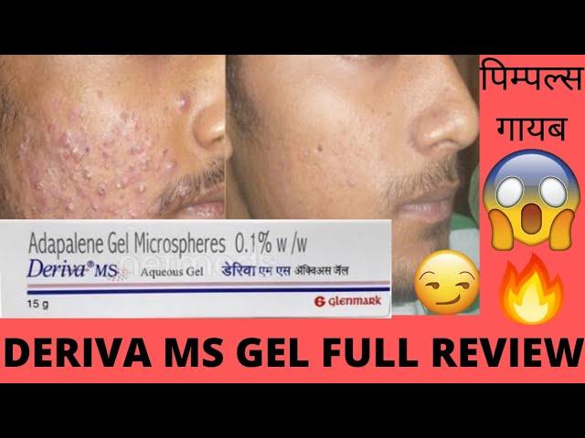 Deriva MS Gel Full review Effects and Side Effects Best for Acne Pimples पिम्पल्स गायब