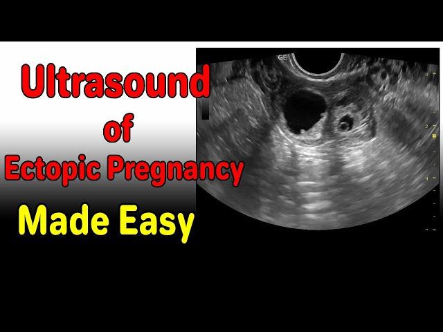 Ultrasound of Ectopic Pregnancy Made Easy