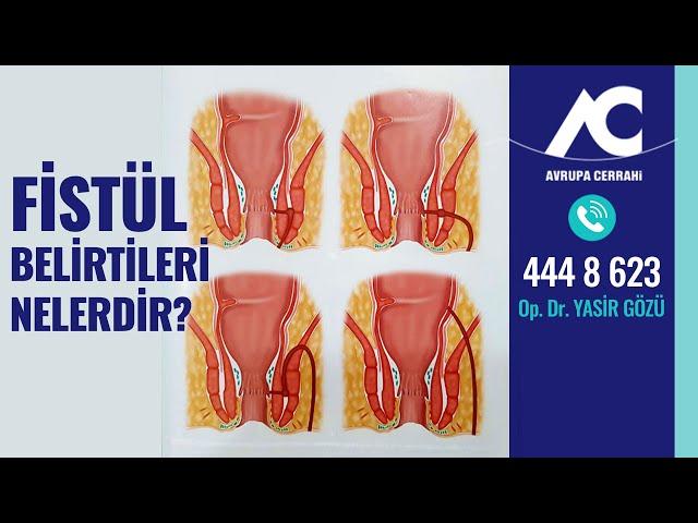 Fistül Belirtileri Avrupa Cerrahi