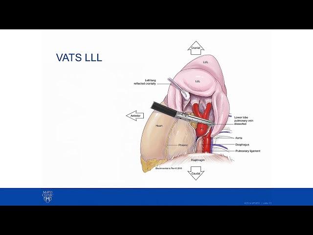 Multifocal Lung Cancer Discussion and Case Presentation