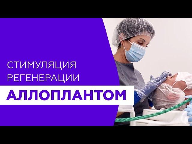 Отзыв пациентки после омоложения Аллоплантом