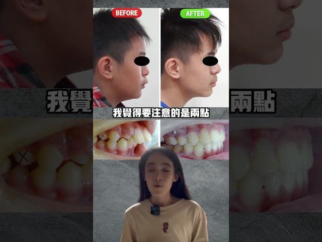 戴牙套能改善下巴後縮嗎#牙齒矯正#二級咬合橡皮筋