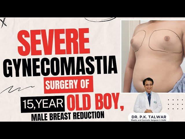 Severe Gynecomastia Surgery of 15-Year-Old Boy, Male Breast Reduction In Delhi, Dr. PK Talwar