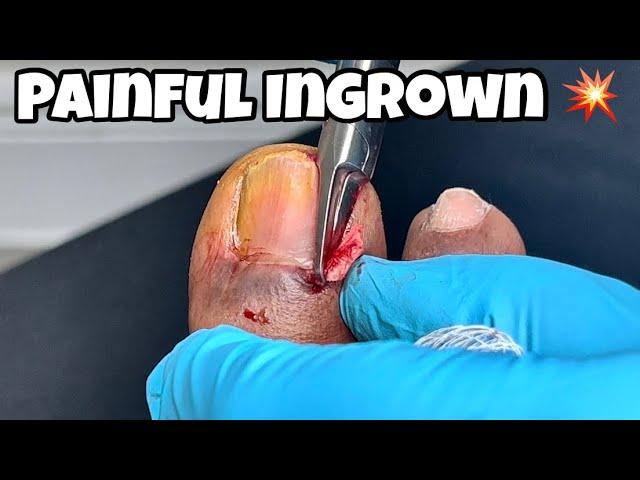 EXTREME PAINFUL INGROWN TOENAIL REMOVAL