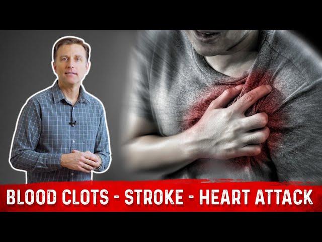 How to Prevent Blood Clots, Strokes & Heart Attacks? – Tips by Dr. Berg