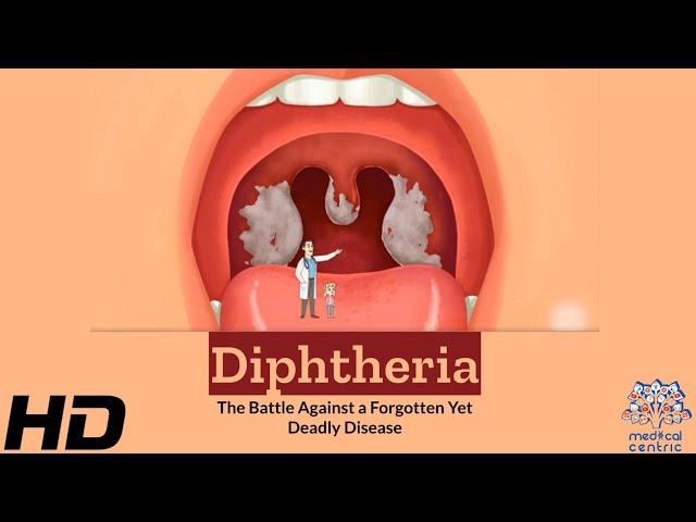 Diphtheria: The Silent Battle Against a Deadly Disease