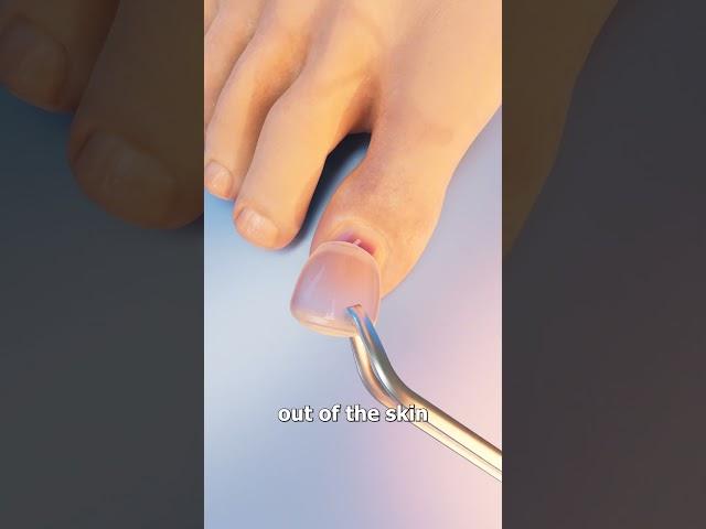 How Toenail Removal Works 
