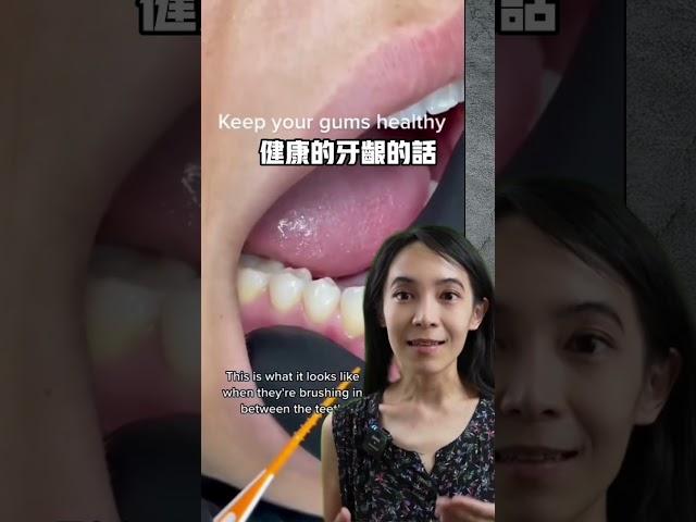 洗牙流很多血是醫生手不巧嗎#洗牙結石#牙周病#牙齦炎