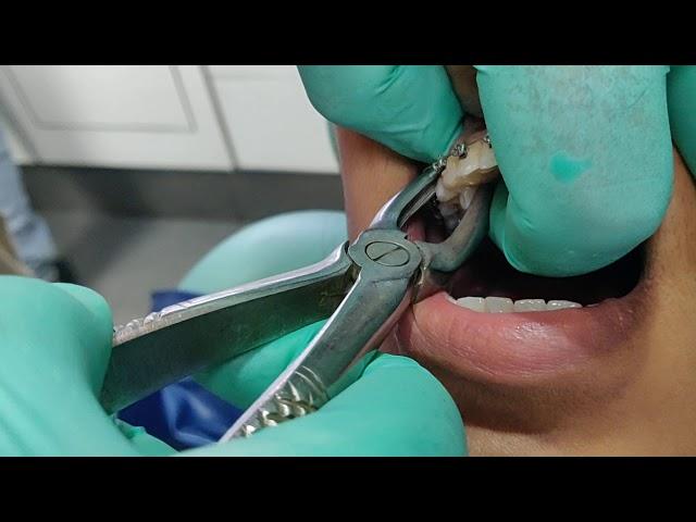 Painless and Easiest method for tooth extraction