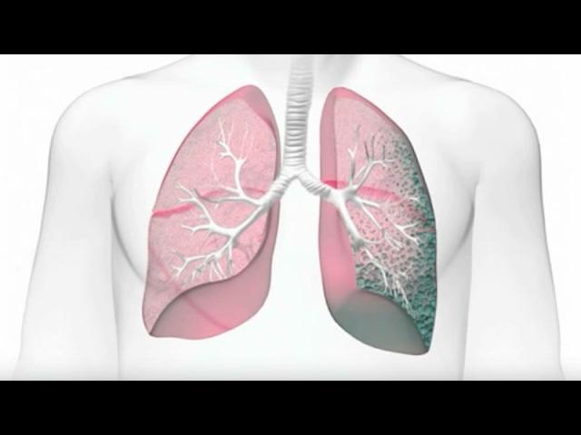 Idiopathic Pulmonary Fibrosis (IPF): Risk Factors and Diagnosis