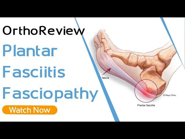 OrthoReview - Plantar Fasciitis | Fasciopathy | Orthopaedic Academy