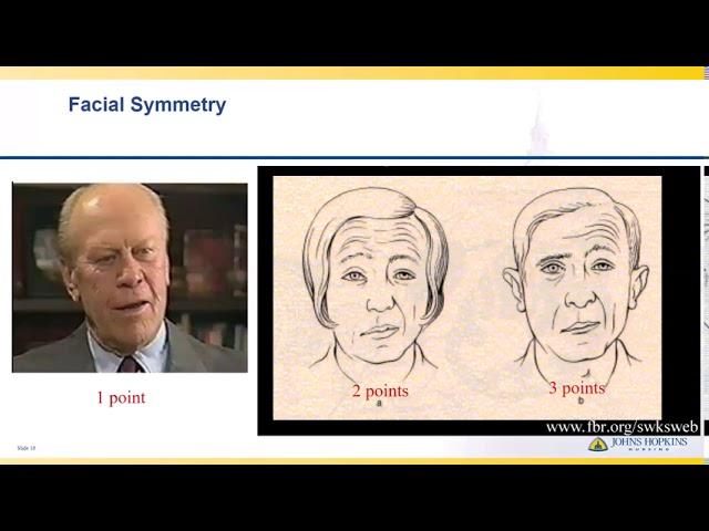 National Institutes of Health Stroke Scale | Lisa Klein