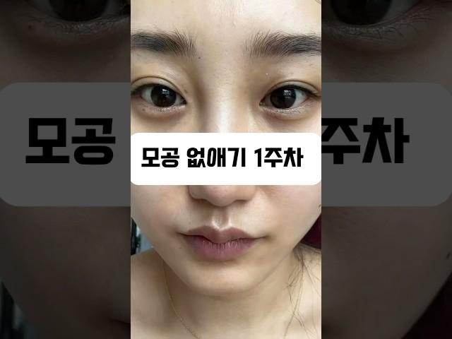 모공순이들 다 나와!!!!!!!