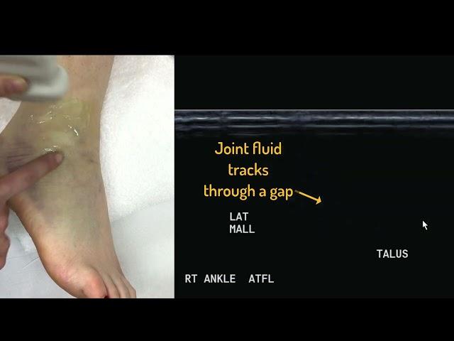 Ultrasound of the Lateral Ankle Ligament Complex Part 1 Tutorial