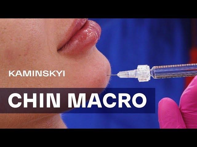 УВЕЛИЧЕНИЕ ПОДБОРОДКА. МАКРОСЪЁМКА | CHIN AUGMENTATION. MACRO EDGAR KAMINSKYI