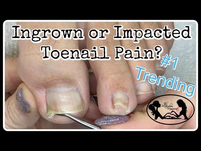 Impacted or Ingrown Toenail Pedicure Tutorial