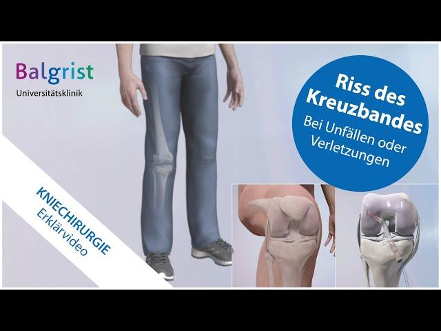 Kreuzbandriss: operative Behandlung vordere Kreuzbandruptur