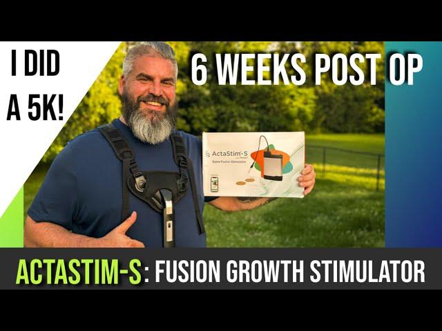 6 Weeks Post-OP From My L4/L5 TLIF Spinal Fusion Surgery and My ActaStim-S Fusion Growth Stimulator