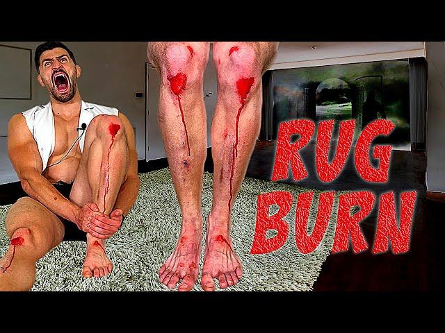 Creating the WORST RUG BURN INJURY of all Time *SCARRED FOR LIFE*